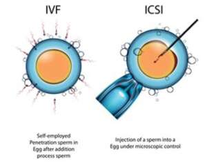 Intracytoplasmic Sperm Injection