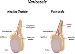 varicoceles