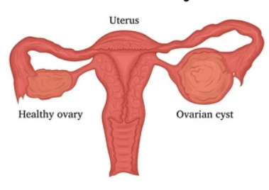 Are Ovarian Cysts More Common After Tubal Ligation?