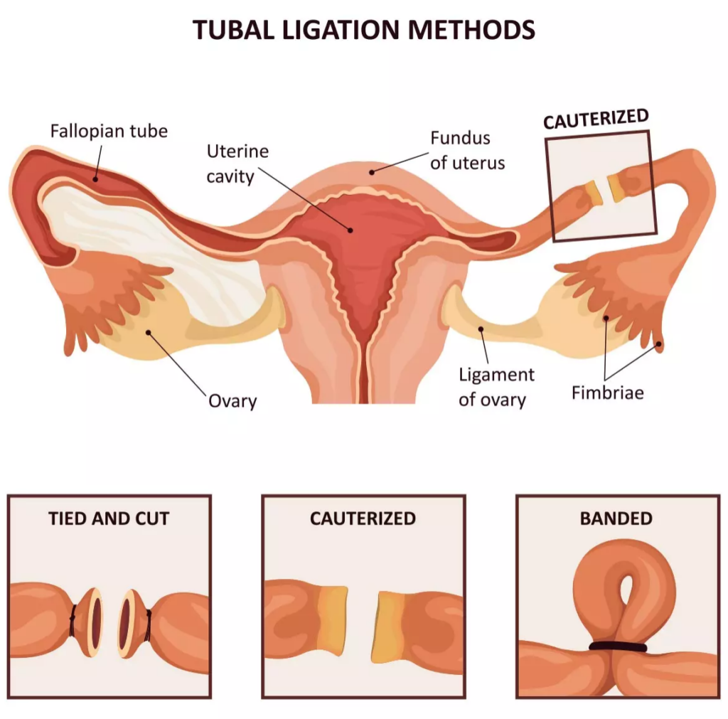 Are Ovarian Cysts More Common After Tubal Ligation?